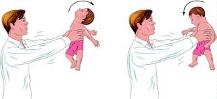 Shaken baby syndrome - SBS